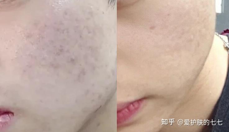 全面步骤指南，最新痘印去除方法详解