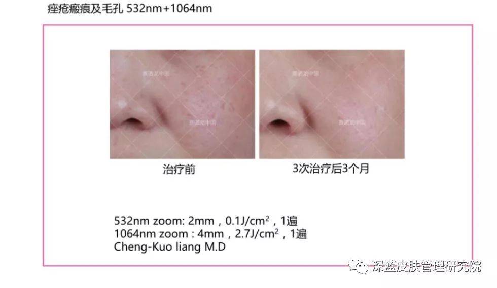最新洗眉仪器，重塑自信，展现真实美