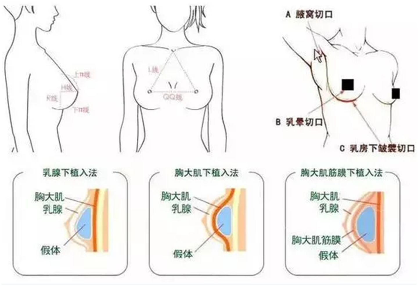 全面审视与观点阐述，最新注射隆胸的发展与趋势